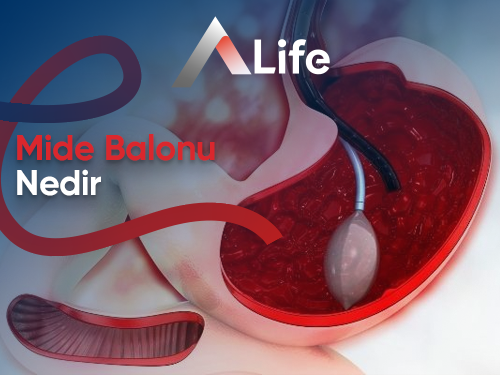 Mide Balonu Nedir?